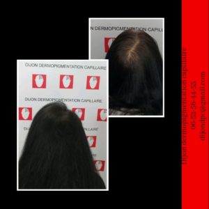 Alopécie stade III-3