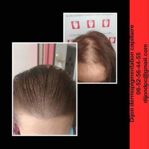 Alopécie stade III-3