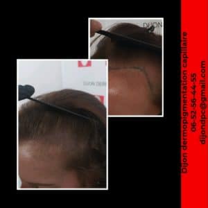 Redéfinition des tempes. Création d'une densité au niveau des golfes