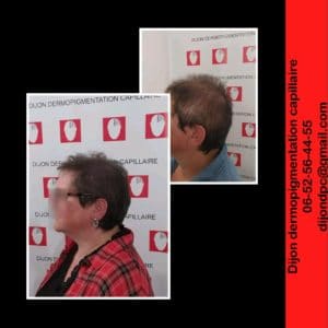 Alopécie de stade avancé. Résultat incroyable!