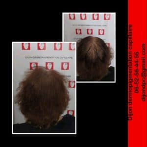 Alopécie stade III-3