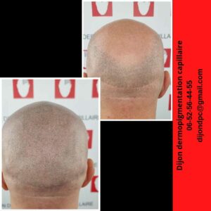 Recouvrement cicatrice FUT