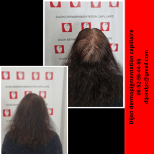 Alopécie stade III-3