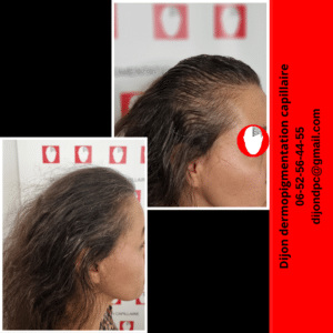 Alopécie stade III-3