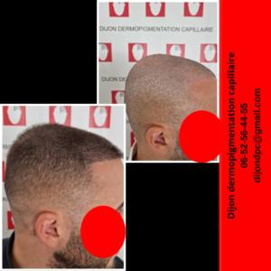 Densification sur greffe FUE