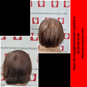 Effet densité, alopécie féminine