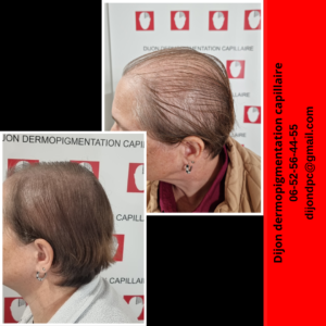 Effet densité, alopécie féminine