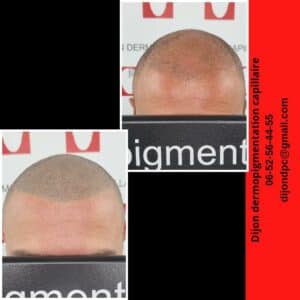 Effet rasé en complément d'une greffe