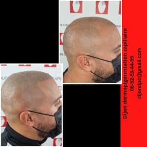 effet rasé en complément d'une greffe