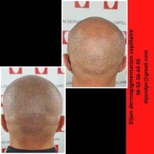 effet rasé en complément d'une greffe