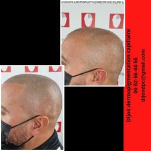 effet rasé en complément d'une greffe