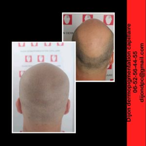 La couronne à disparue! Les rougeurs disparaissent dans les 24h!