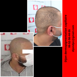 cicatrices greffe FUE